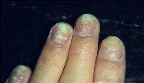 手上得了灰指甲怎么办？用什么药才能治好？