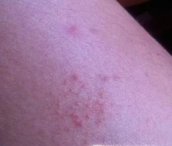 被不知名的虫子咬伤怎么办