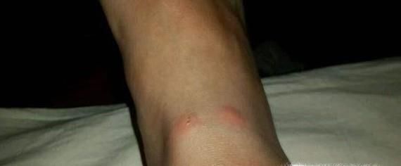 被不知名的虫子咬伤怎么办