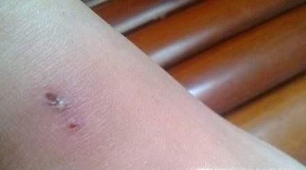 被不知名的虫子咬伤怎么办