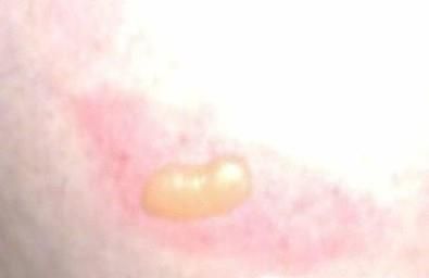 被不知名的虫子咬伤怎么办