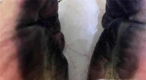 鞋子掉色染脚上洗不掉怎么办