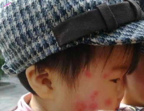 夏天被蚊子咬了如何快速消肿