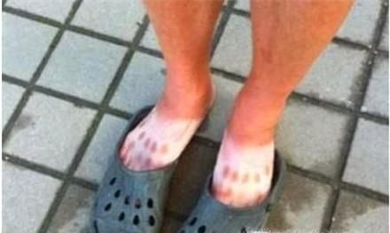 洞洞鞋的危害有哪些,洞洞鞋危害详解