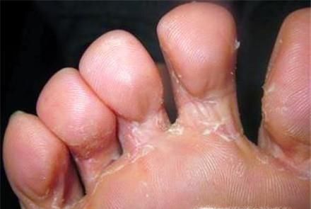 洞洞鞋的危害有哪些,洞洞鞋危害详解