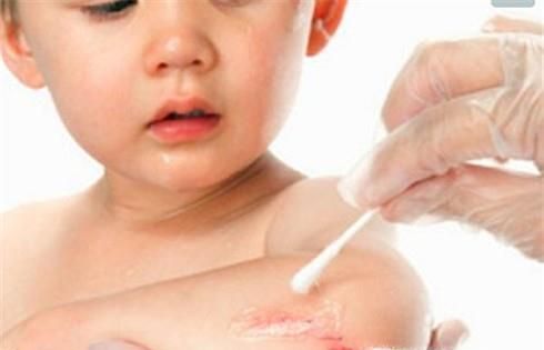 如何预防伤口感染发炎？