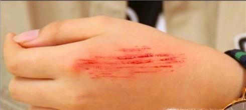 如何预防伤口感染发炎？