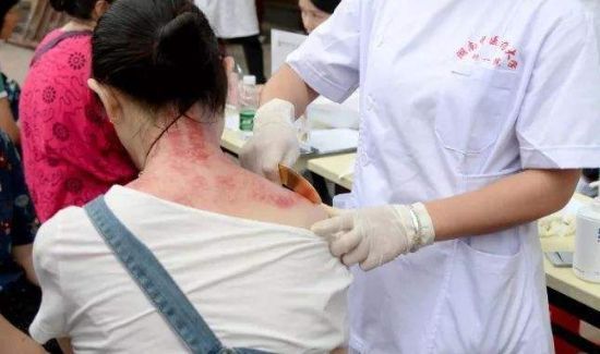 刮痧第二天可以游泳吗