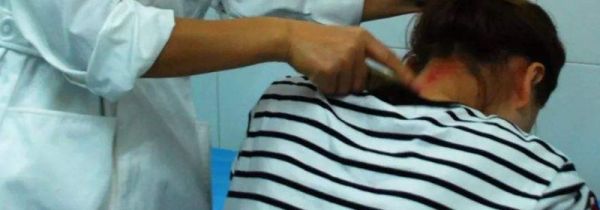 刮痧第二天可以游泳吗