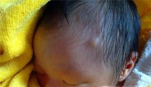 不小心撞到头怎么办