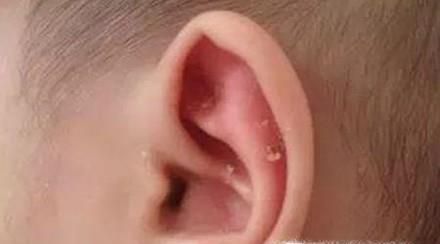 耵聍对生活的影响及如何正确挖取耵聍