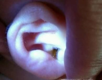 耵聍对生活的影响及如何正确挖取耵聍