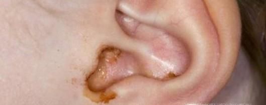 耵聍对生活的影响及如何正确挖取耵聍