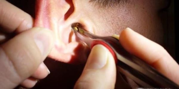 掏耳朵导致耳朵疼怎么办