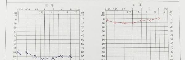 长期用耳塞听歌会导致听力下降吗？