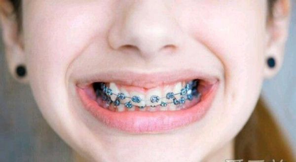 戴牙套需要注意些什么,相貌真的会有改变吗?
