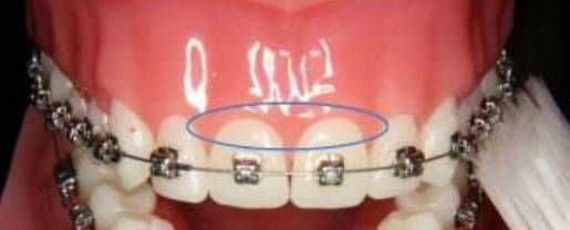 戴牙套需要注意些什么,相貌真的会有改变吗?