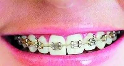 戴牙套需要注意些什么,相貌真的会有改变吗?