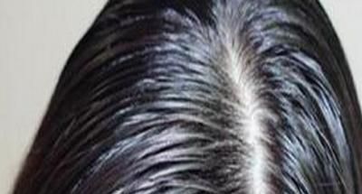 我的头发两天不洗就油得不行，是不是身体有问题啊？