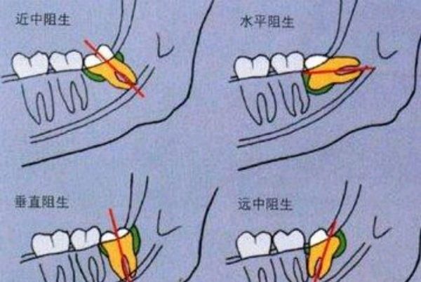 拔智齿有多痛?智齿一定要拔吗?