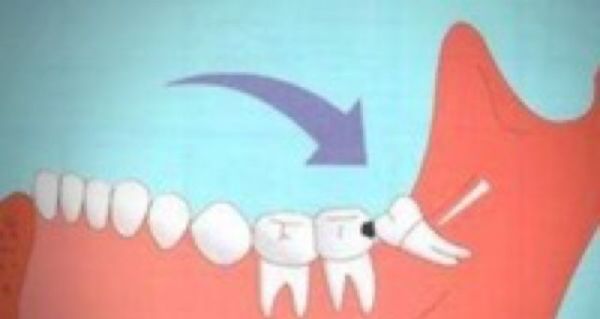 拔智齿有多痛?智齿一定要拔吗?