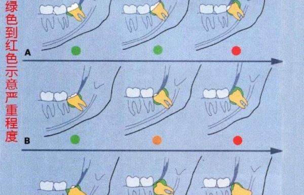 拔智齿有多痛？智齿一定要拔吗？