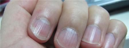 指甲上有竖纹是怎么回事？