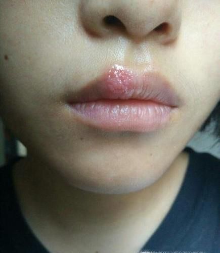 下嘴唇起泡怎么办