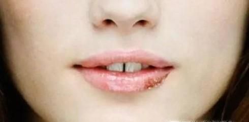 下嘴唇起泡怎么办