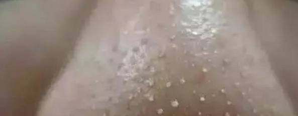 你知道鼻子上挤出的“白色物体”到底是什么吗?