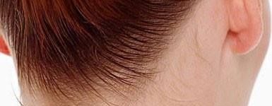 为什么很多人脖子后面都有一颗痣？