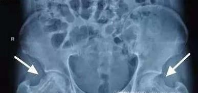 股骨头在人体的哪个位置及作用