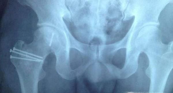 股骨头在人体的哪个位置及作用