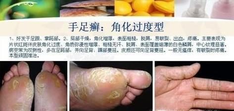 足癣图片大全