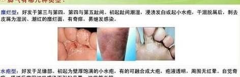足癣图片大全