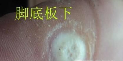 肉刺长什么样子，脚上肉刺图片