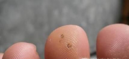 肉刺长什么样子，脚上肉刺图片