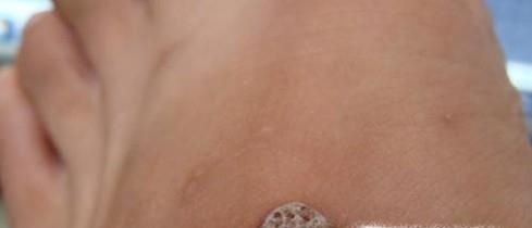 肉刺长什么样子，脚上肉刺图片