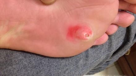 肉刺长什么样子，脚上肉刺图片