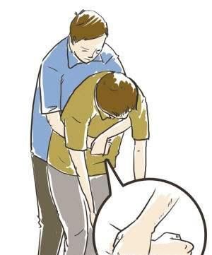 海姆立克急救法