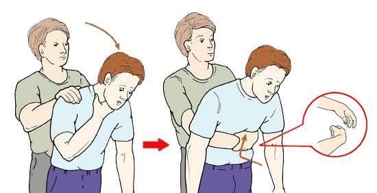 海姆立克急救法