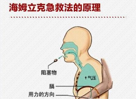 海姆立克急救法